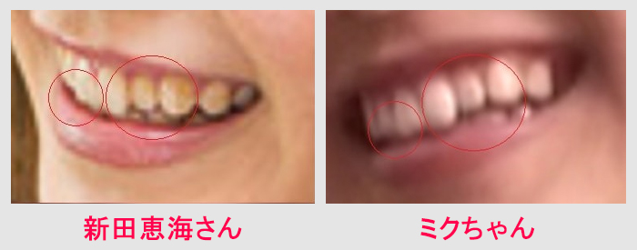 新田恵海の歯並び検証1